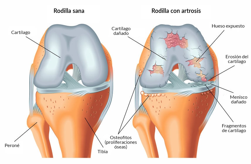 Sobre “Artrosis de rodilla” se habló en las  charlas de salud del MIDME